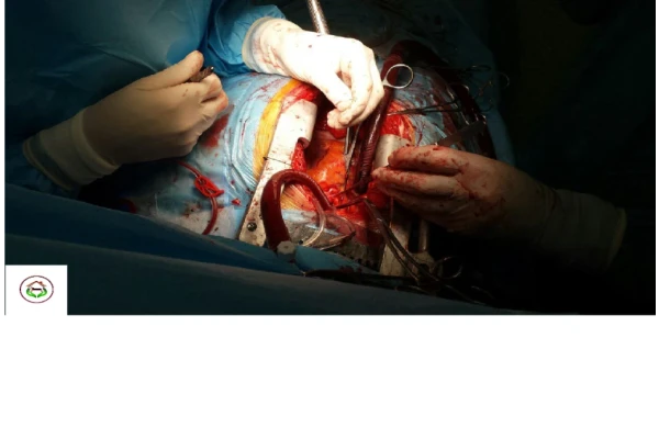 اطلاعات جامع و کامل درباره عمل جراحی پیوند عروق کرونری قلب