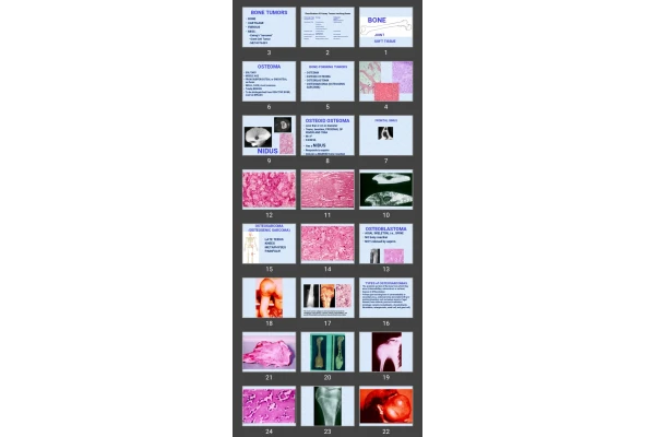 پاورپوینت BONE TUMORS