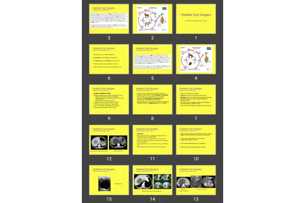 پاورپوینت کیست هیداتید Hydatid Cyst Surgery