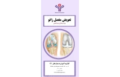 پمفلت تعویض مفصل زانو