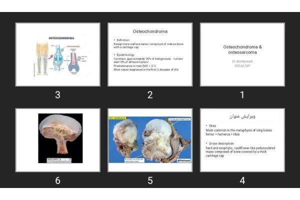 پاورپوینت Osteochondroma & osteosarcoma