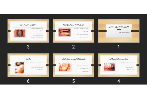 پاورپوینت هایپرپیگمانتاسیون ملانینی منتشر