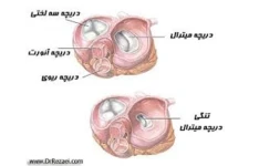 اطلاعات کامل و جامع درباره بیماری‌های دریچه‌های قلبی بیماری‌ها, بیماری دریچه قلبی, دریچه قلب