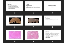 پاورپوینت Cirrhosis & HCC
