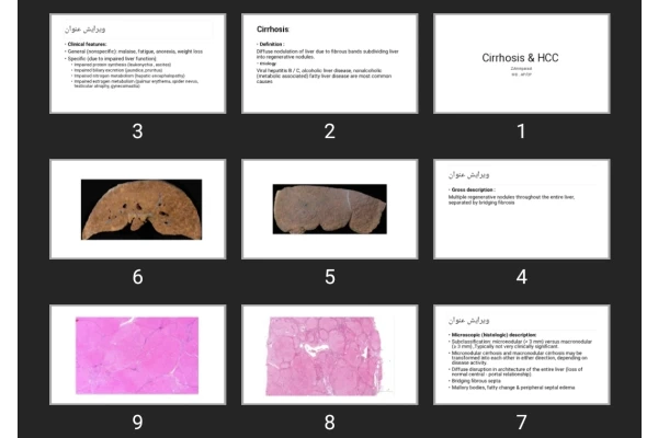 پاورپوینت Cirrhosis & HCC