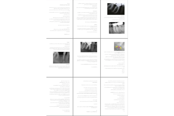 جزوه پركردن كانال  OBTURATION of the ROOT CANAL SYSTEM