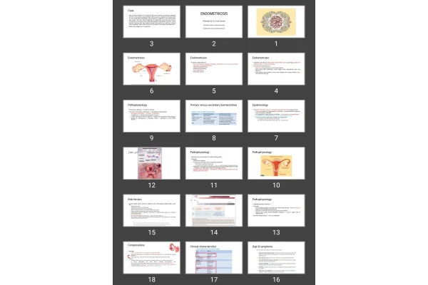 پاورپوینت ENDOMETRIOSIS