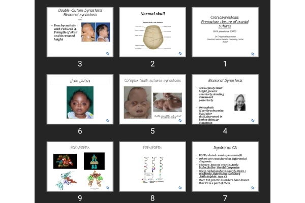 پاورپوینت Craniosynostosis Premature closure of cranial sutures
