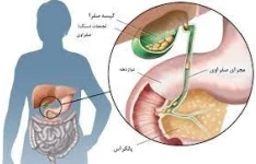   فایل سنگ کیسه صفرا