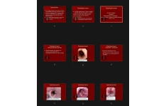 جزوه Esophageal cancer