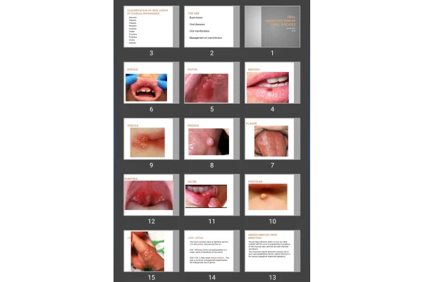 پاورپوینت تظاهرات دهانی ویروسی Oral manifestation of viral diseases