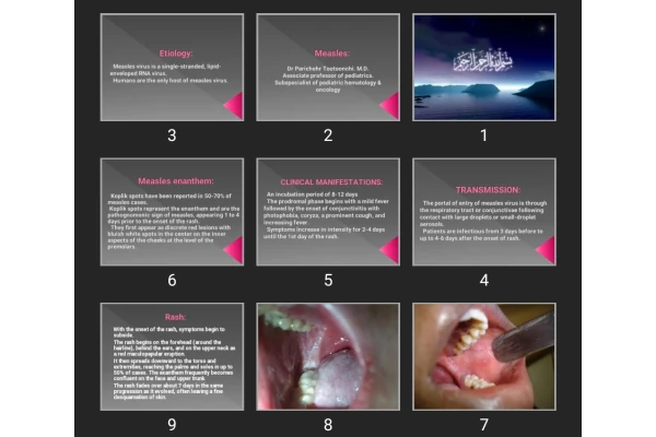 پاورپوینت Measles