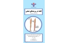 پمفلت لخته در وریدهای عمقی