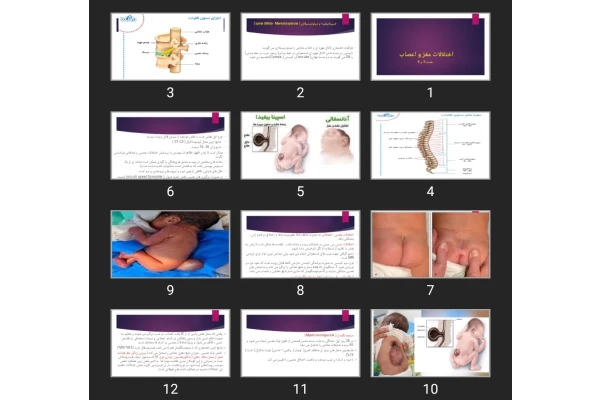 پاورپوینت اختلالات مغز و اعصاب