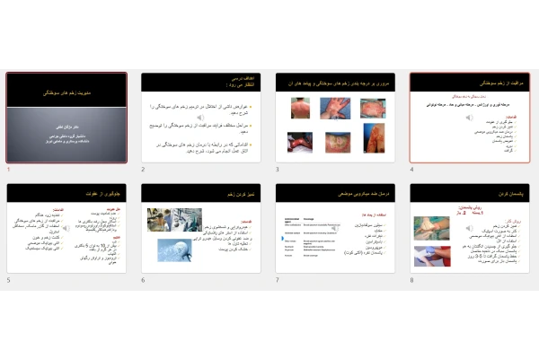 پاورپوینت مدیریت زخم های سوختگی