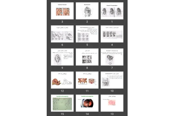 پاورپوینت Breech Presentation