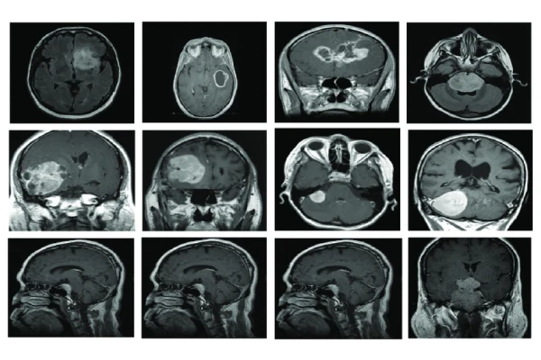 مطالعه و ارزیابی روش های طبقه بندی  تصاویر MRI و CT مغز