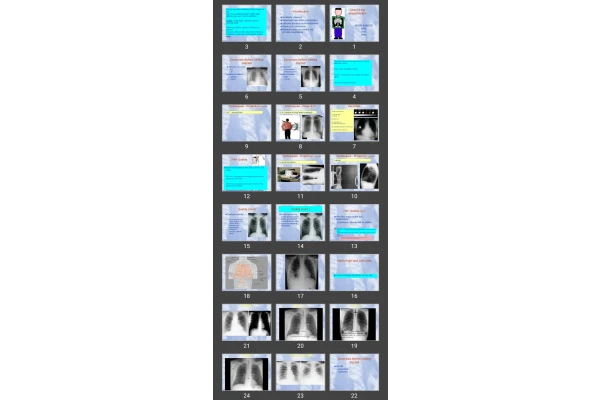 پاورپوینت Chest X-ray Interpretation