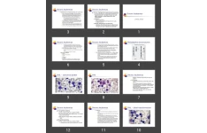 پاورپوینت لوسمی مزمن Chronic leukemias