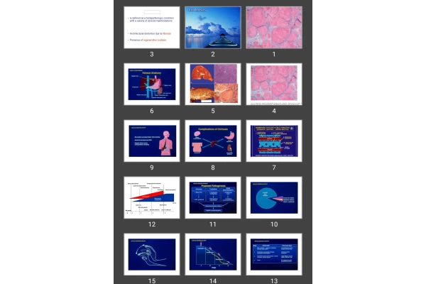 پاورپوینت Cirrhosis