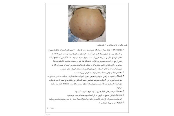جزوه مقدمات بیماری های گوارش و کبد، آسیت