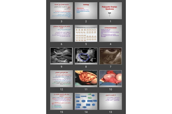 پاورپوینت سندروم تخمدان پلی كيستيک Polycystic Ovarian Syndrome