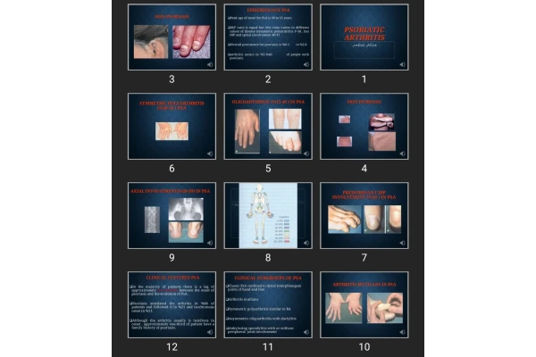 پاورپوینت Psoriatic Arthritis