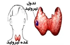   فایل اپروچ (برخورد) به ندول تیرویید