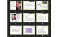 پاورپوینت CARDIAC TUMORS