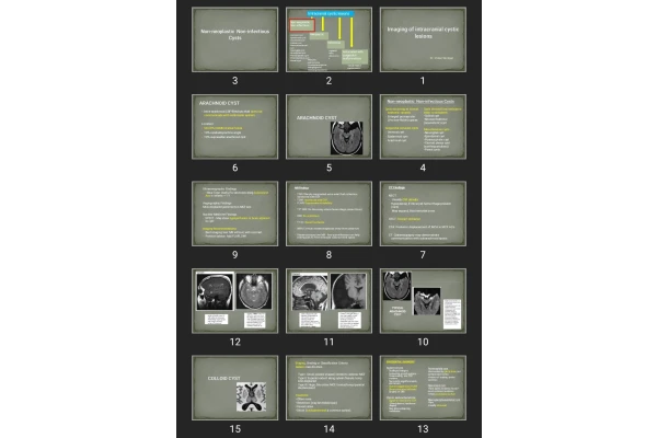 پاورپوینت Imaging of intracranial cystic lesions