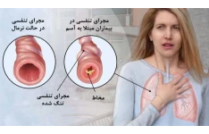 پمفلت آموزشی بیماری آسم راهنمای بیماران، قابل استفاده برای دانشجویان ، کارکنان بهداشتی و درمانی و بیماران