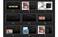 پاورپوینت آماده سازی حفره کلاس V آمالگام