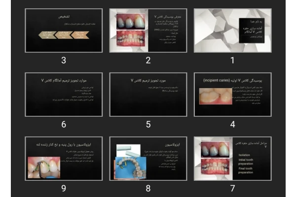 پاورپوینت آماده سازی حفره کلاس V آمالگام