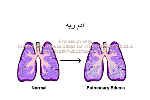 پاورپوینت ادم ریه      تعداد اسلاید : 26      نسخه کامل✅