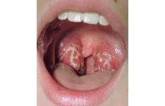   فایل اپرچ به acute pharyngitis در بالغین