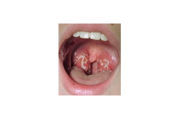   فایل اپرچ به acute pharyngitis در بالغین