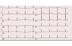 جزوه آموزش نوار قلب (ECG)برای پرستاران