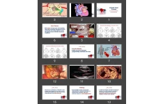 پاورپوینت اندوکاردیت Valvular Heart Disease