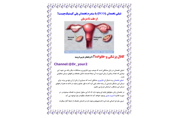 تخمدان پلی کيستيک 🔬 نسخه کامل ✅