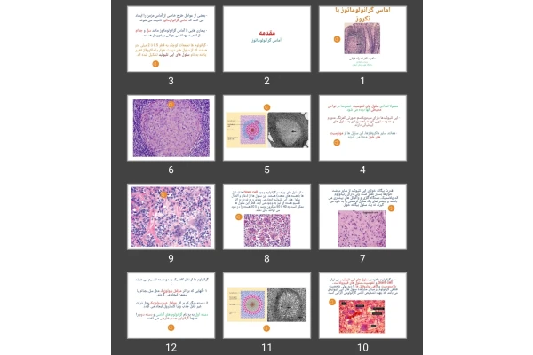 پاورپوینت آماس گرانولوماتوز با نکروز
