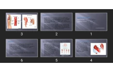 پاورپوینت Aortic dissection