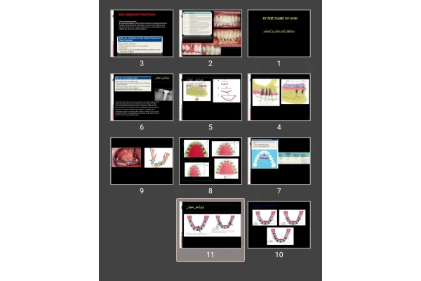 پاورپوینت درمان های ثابت متکی بر ایمپلنت