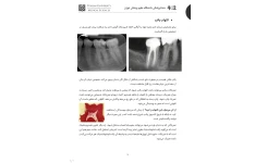 جزوه کمپلکس پالپ و پری‌اپیکال - بیماری‌های پالپ: یافته‌های هیستولوژیک، کلینیکی و رادیوگرافیک