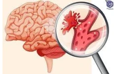   پاورپوینت خونریزی مغزی IntraCranial Haemorrhage