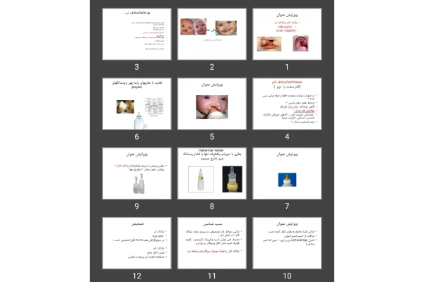 پاورپوینت شکاف کام و شکاف لب