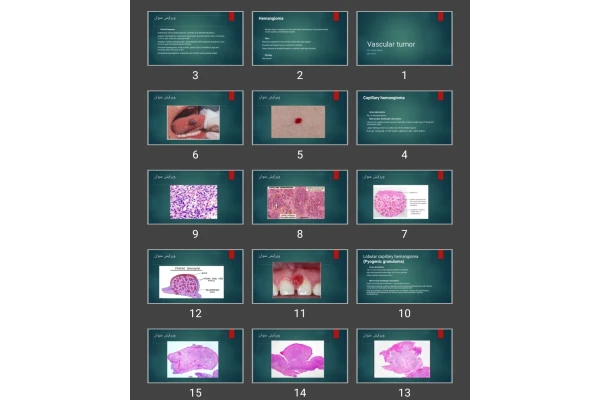 پاورپوینت Vascular tumor