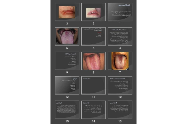 پاورپوینت كيلوكانديدوزيس