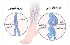   جزوه بیماری های وریدی venous disease  دانشگاه علوم پزشکی تهران