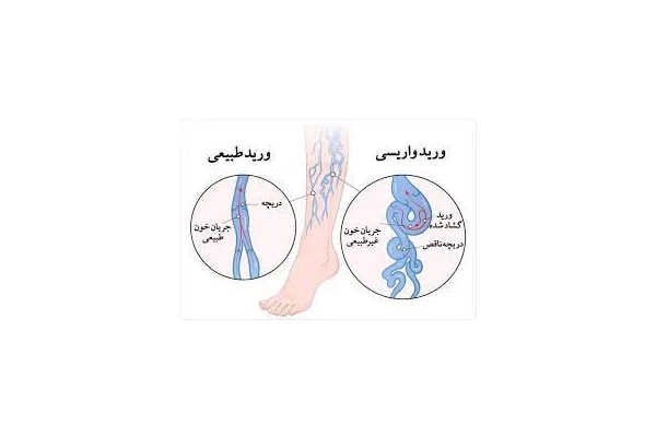   جزوه بیماری های وریدی venous disease  دانشگاه علوم پزشکی تهران