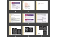 پاورپوینت  Multiple Sclerosis MS